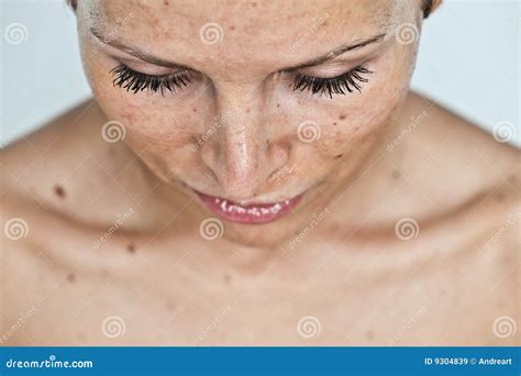 Woman With Sunburn Stock Image Image Of Suffering Scar 9304839