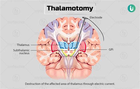 Thalamotomy Procedure Purpose Results Cost Price