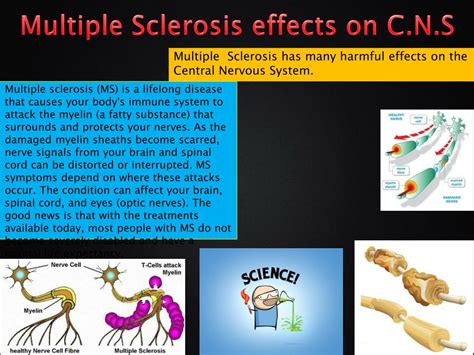 Ppt Multiple Sclerosis Powerpoint Presentation Free Download Id 1867144