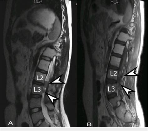 Follow Up Mri Lumbar Spine Sagittal View A T2 Weighted And B T1