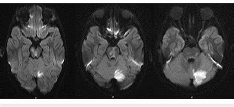 Dwi Sequence With Ischemic Changes In The Midbrain Pons And Left