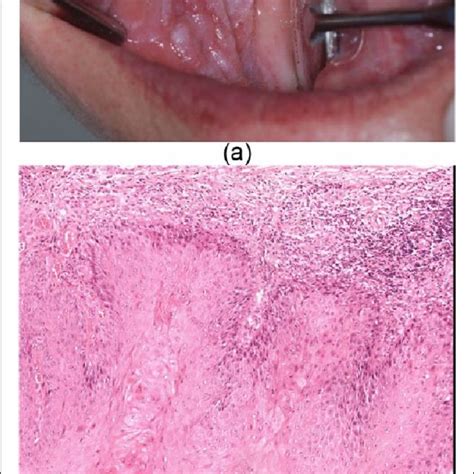 A Reticular Erosive Lesions On Both Cheeks Appeared 2 Years After