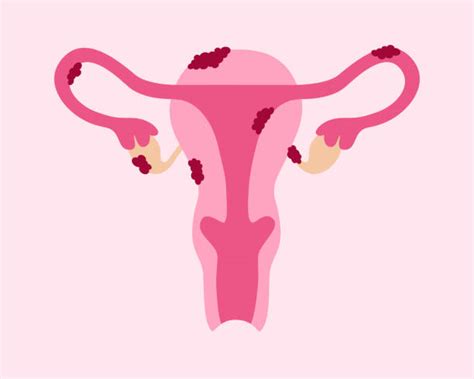 Endometriosis And Fertility Navigating The Complex Path L Natural