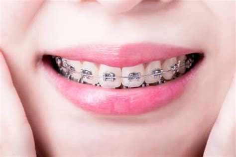 Arvada CO Braces Metal Braces Hardy Orthodontics