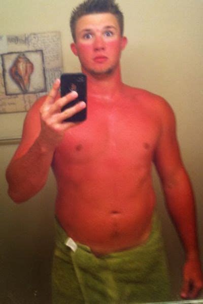 These Insane Sunburns Will Make You Want To Hide Indoors Cottage Life