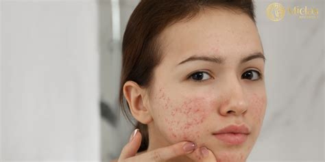 Understanding Effective Acne Treatments Causes And Prevention