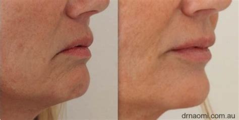 Jawline Filler Experienced Doctors At Our Sydney Clinic