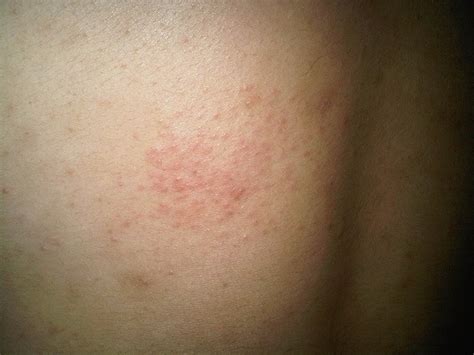 Pinpoint Red Dots On Skin Stomach Hopslide