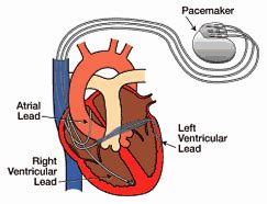 Pacemakers and implantable cardioverter defibrillators (icd) both use wires called leads to send electrical signals to the heart. Robotic Pacemaker Lead Placement, Cardiac ...