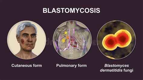 Clinical Forms Of Blastomycosis 3d Illustration Stock Illustration Illustration Of Dermatitis