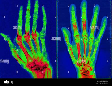 Rheumatoid Arthritis Hands X Ray Hi Res Stock Photography And Images