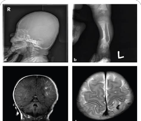 Radiographic Findings Of The Newborn Patient With Osteogenesis