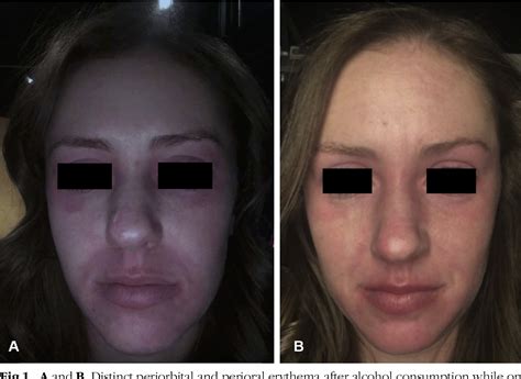 Figure 1 From Alcohol Induced Facial Flushing In A Patient With Atopic