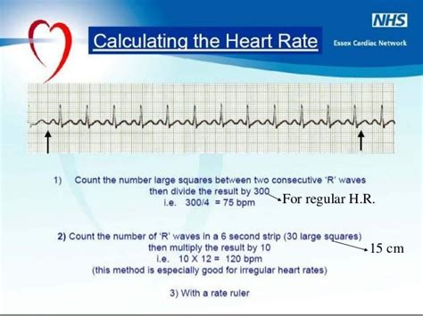 How To Calculate Heart Rate From Ecg A Level Biology Photos Idea