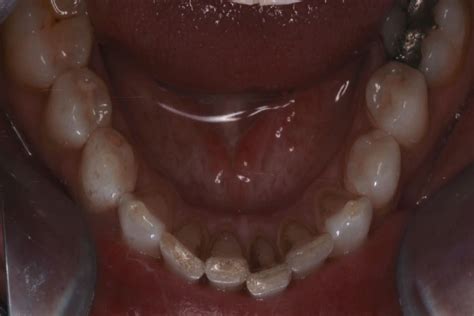 Inman Aligner Upper And Lower Arch Crowding By Dr Funmi Sijuwade Ias