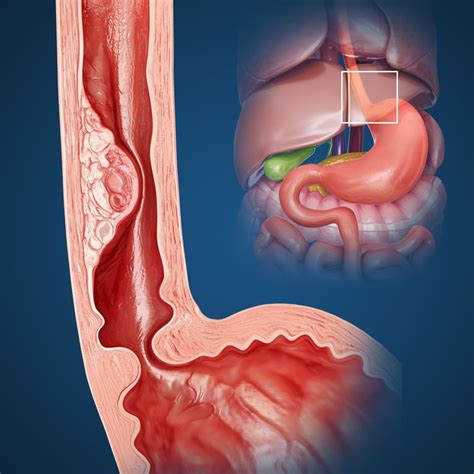 Esophageal Stricture Symptoms Causes And Treatment Gastroenterology