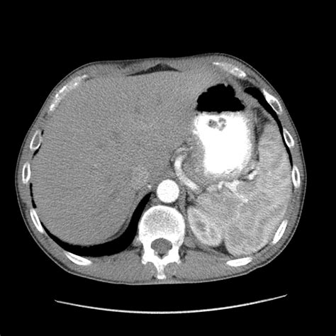 Normal arterial phase CT appearance of the spleen | Image | Radiopaedia.org
