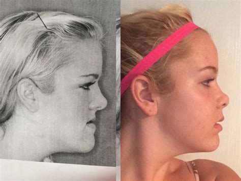 The Before And After Of My Jaw Surgery Imgur