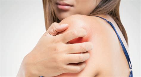 Dermatite Atopica Cos Cause Sintomi E Rimedi Naturali