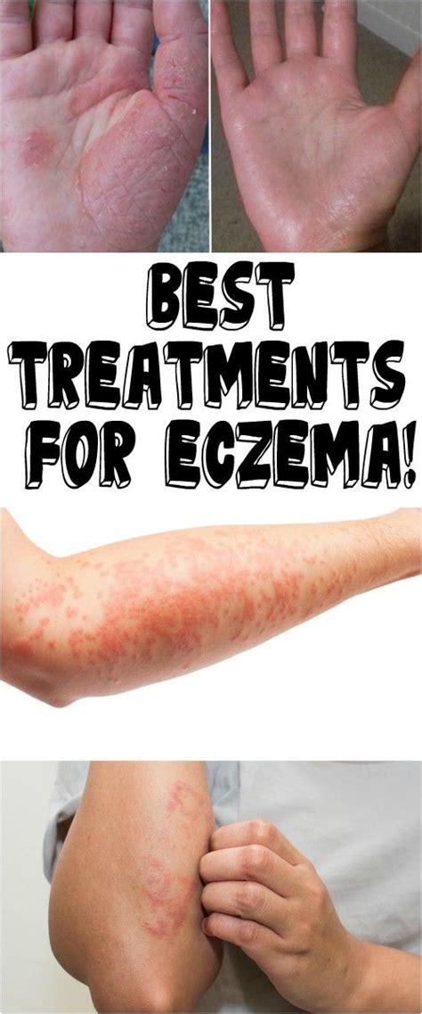 Best Treatments For Eczema Health Roots