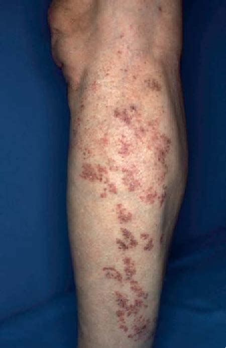 Figure 2 From Lichen Planus Occurring After Influenza Vaccination