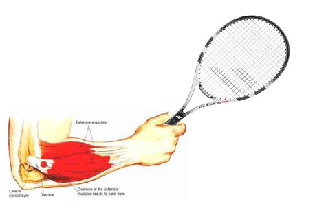 Tennis Elbow And What You Should Know Port Melbourne Physiotherapy