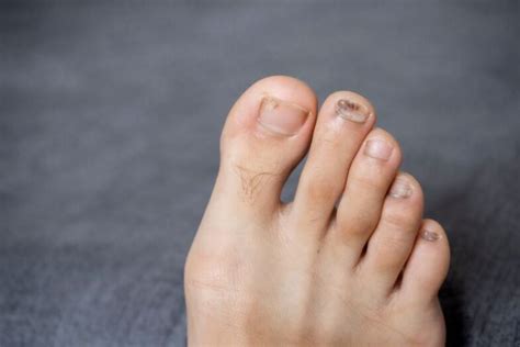 Is Toenail Fungus Common Foot And Ankle Podiatrists