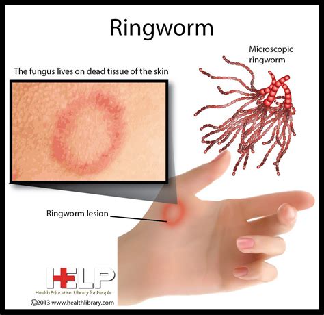 Ringworm Tinea Mycoses Micro