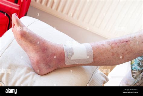 Swollen Ankles High Resolution Stock Photography And Images Alamy