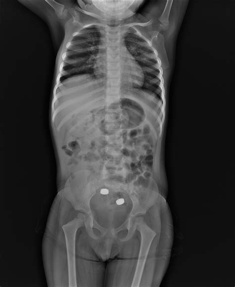 Foreign Body In Gastrointestinal Tract Image