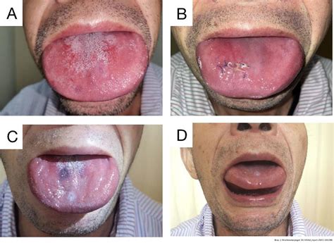 Amyloidosis Of The Tongue A Rare Case Report Brazilian Journal Of