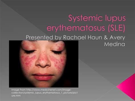 Ppt Systemic Lupus Erythematosus Sle Powerpoint Presentation Free
