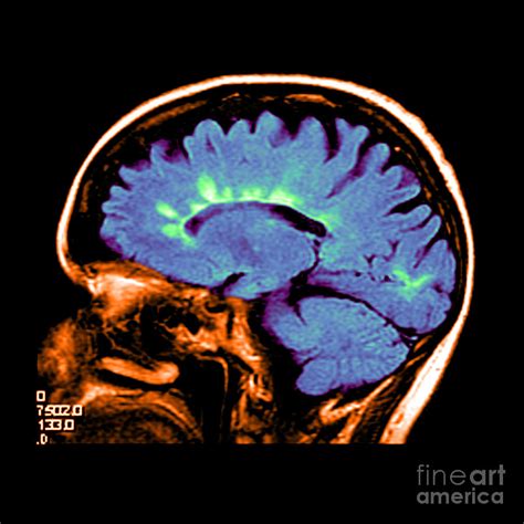 Mri Of Multiple Sclerosis Photograph By Medical Body Scans Pixels