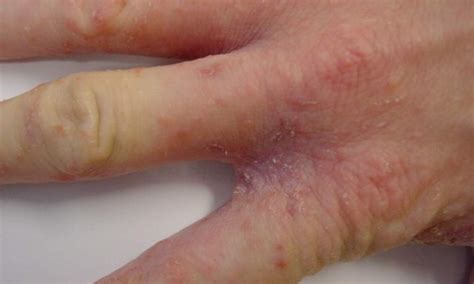 Scabies Rash On Palm Of Hand Porn Sex Picture