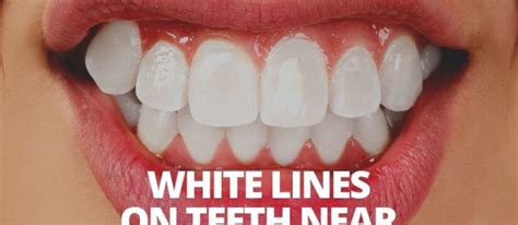 White Lines On Teeth Near Gums Symptoms And Treatment
