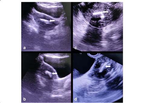 Transabdominal Axial A And Sagittal B Sonogram In A 27 Year Old