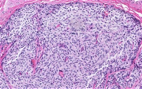 Pathology Outlines Carcinoid Tumorlet