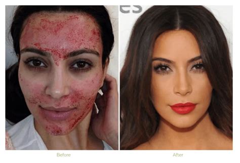Vampire Facial Before And After Acne Scars A Promising Treatment For