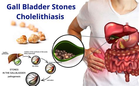 Gallbladder Treatment In Homeopathy Captions Trend Update