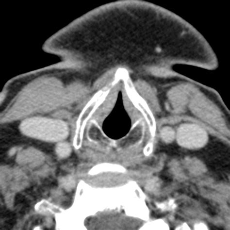 Imaging Of Ectopic Thyroid Tissue And Thyroglossal Duct Cysts