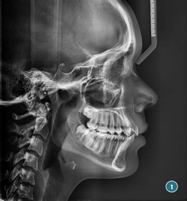 Telerradiografía de Cráneo Lateral o Frontal Radiología Dental Las Palmas