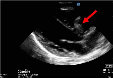 Seven Year Old Male With Tricuspid Endocarditis Pocus Journal