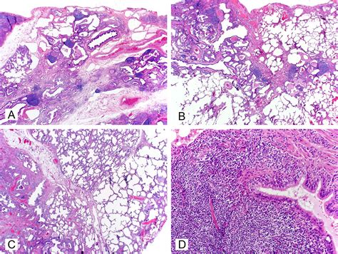 Usual Interstitial Pneumonia Pattern Fibrosis In Surgical Lung Biopsies