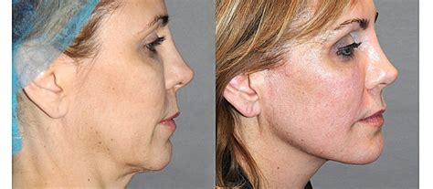 Y Lift ® Nonsurgical Facelift Lunchtime Facelift View Patient Photos