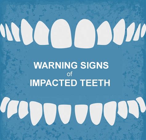 Warning Signs Of Impacted Wisdom Teeth