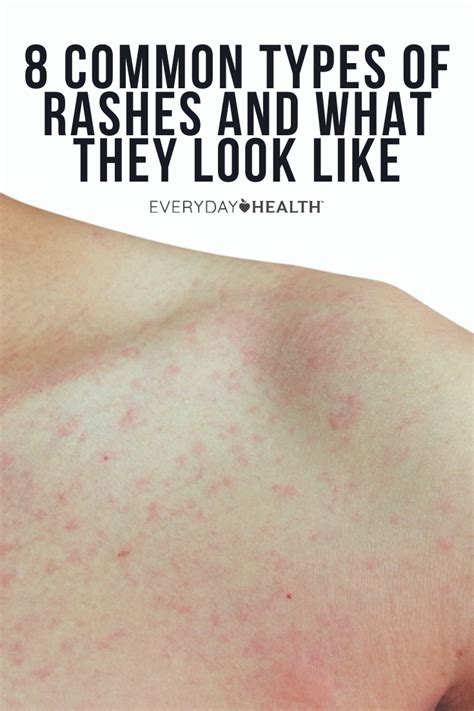 8 Common Types Of Rashes And What They Look Like Types Of Rashes
