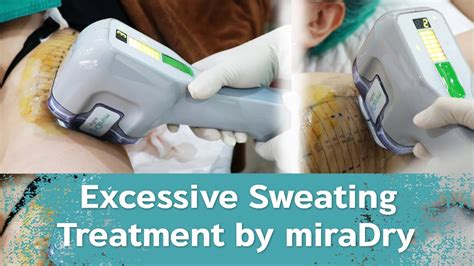 Hyperhidrosis Or Excessive Sweating Treatment By Miradry Youtube