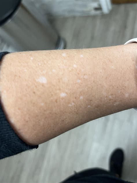 I Get These White Blemishes All Over My Arms Any Way I Can Get Rid Of