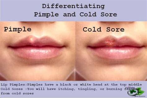 How To Get Rid Of A Pimple On Lip Best 9 Remedies