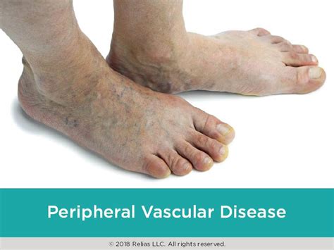 Peripheral Vascular Disease Relias Academy